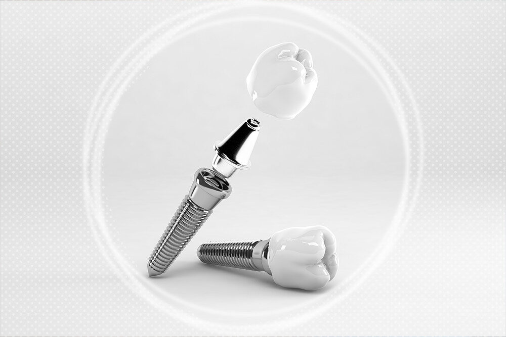 How do one-day dental implants work?