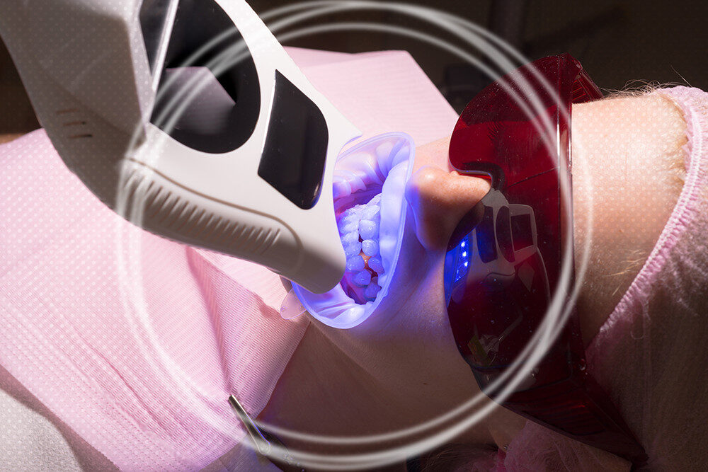 Most Common Laser teeth cleaning side effects