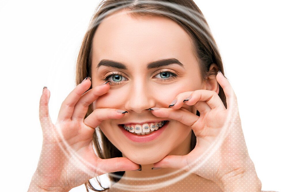 Gummy Smile Braces Treatment: 7 Steps For Better Results