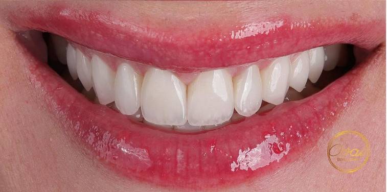 Best Place for Veneers in Dubai