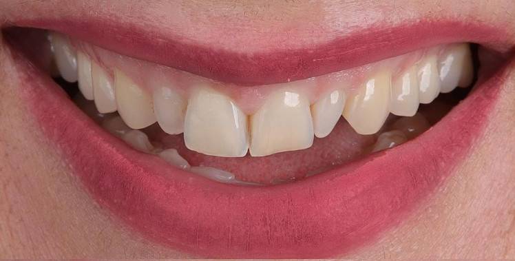 After Smile 2