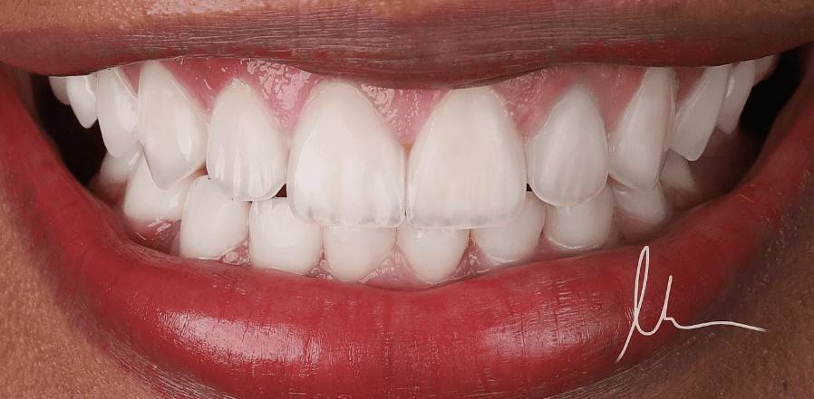 Before Smile 1